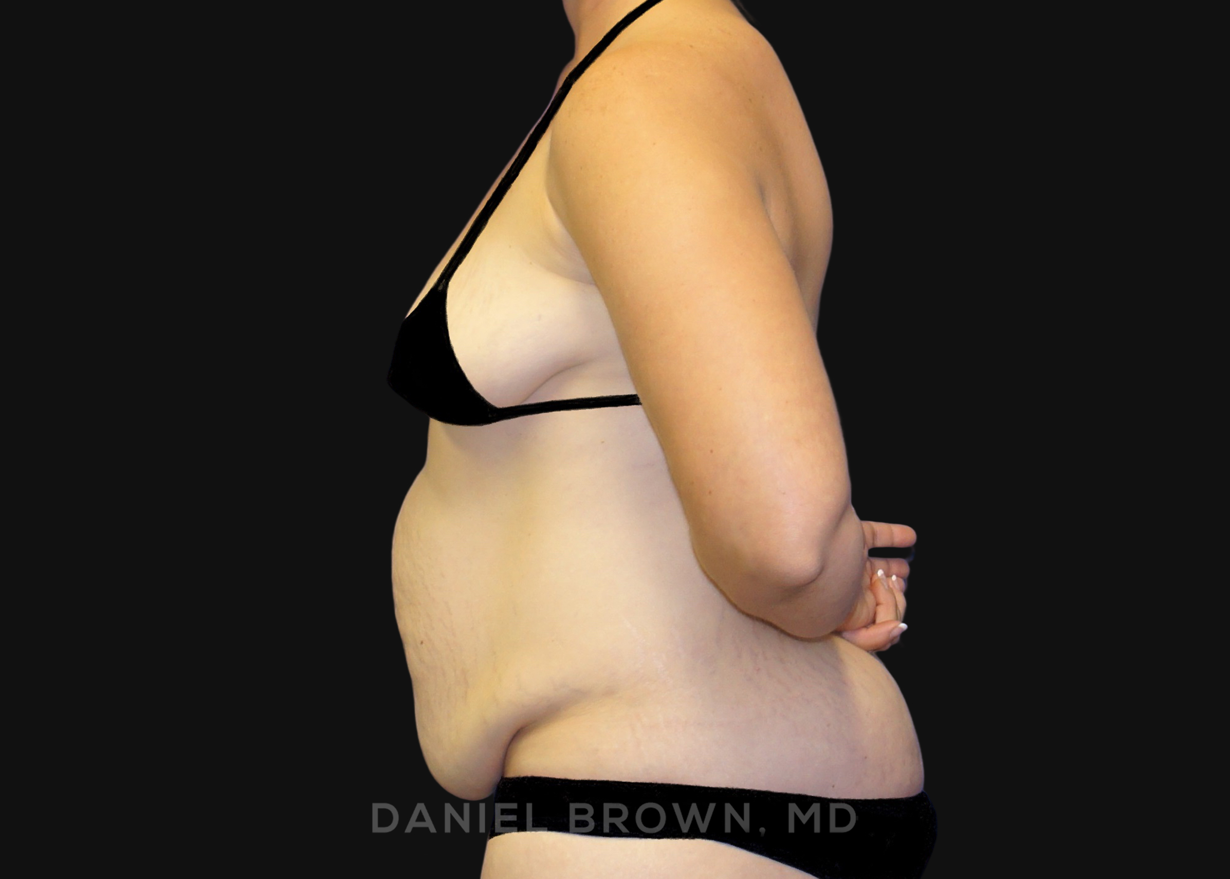 Tummy Tuck Patient Photo - Case 1156 - before view-