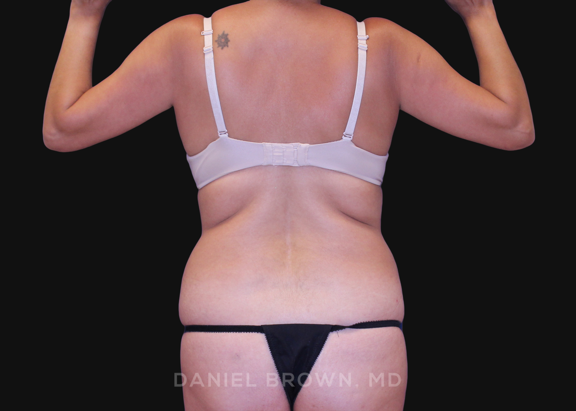 Tummy Tuck Patient Photo - Case 1163 - before view-5