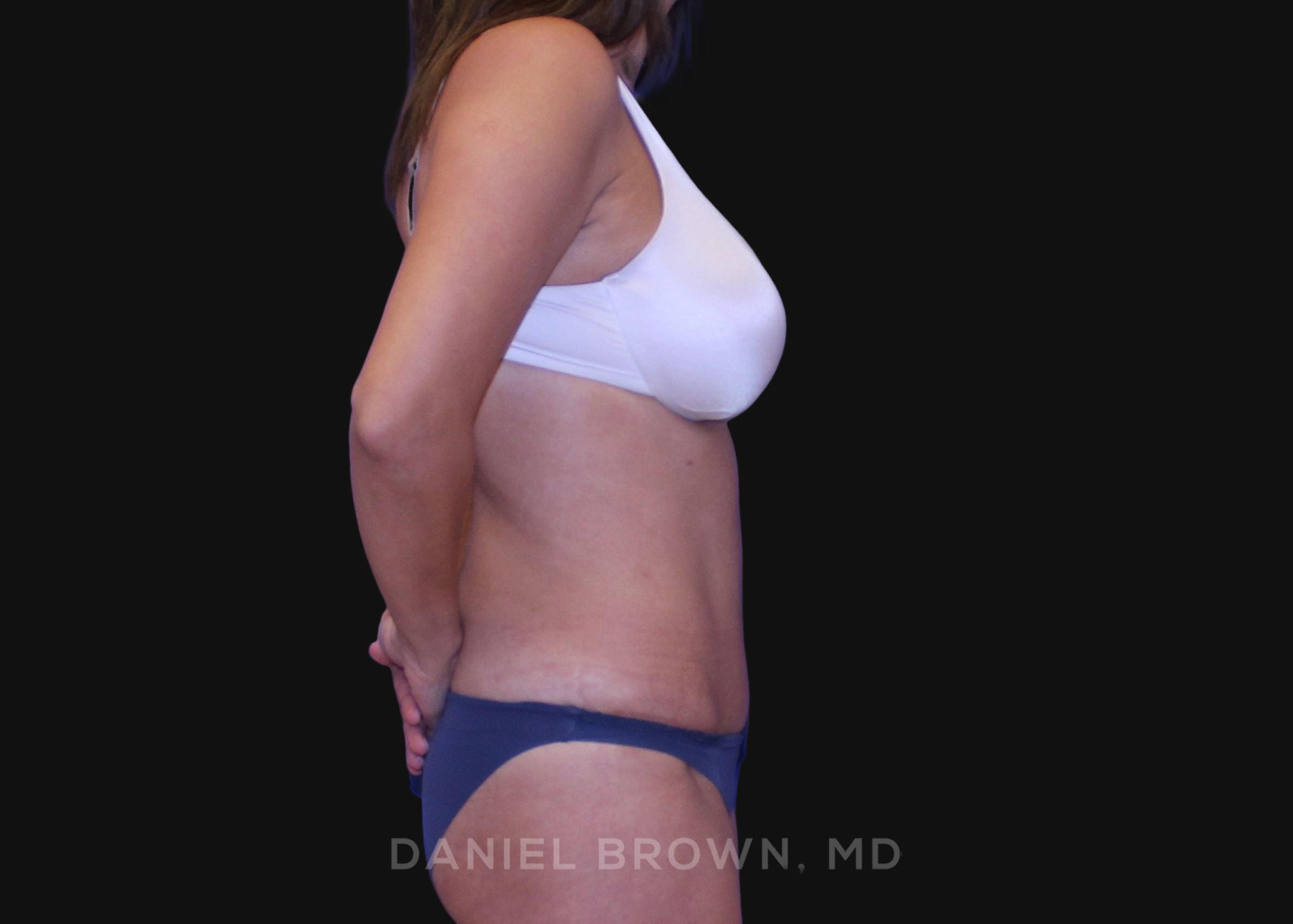 Tummy Tuck Patient Photo - Case 1163 - after view-4