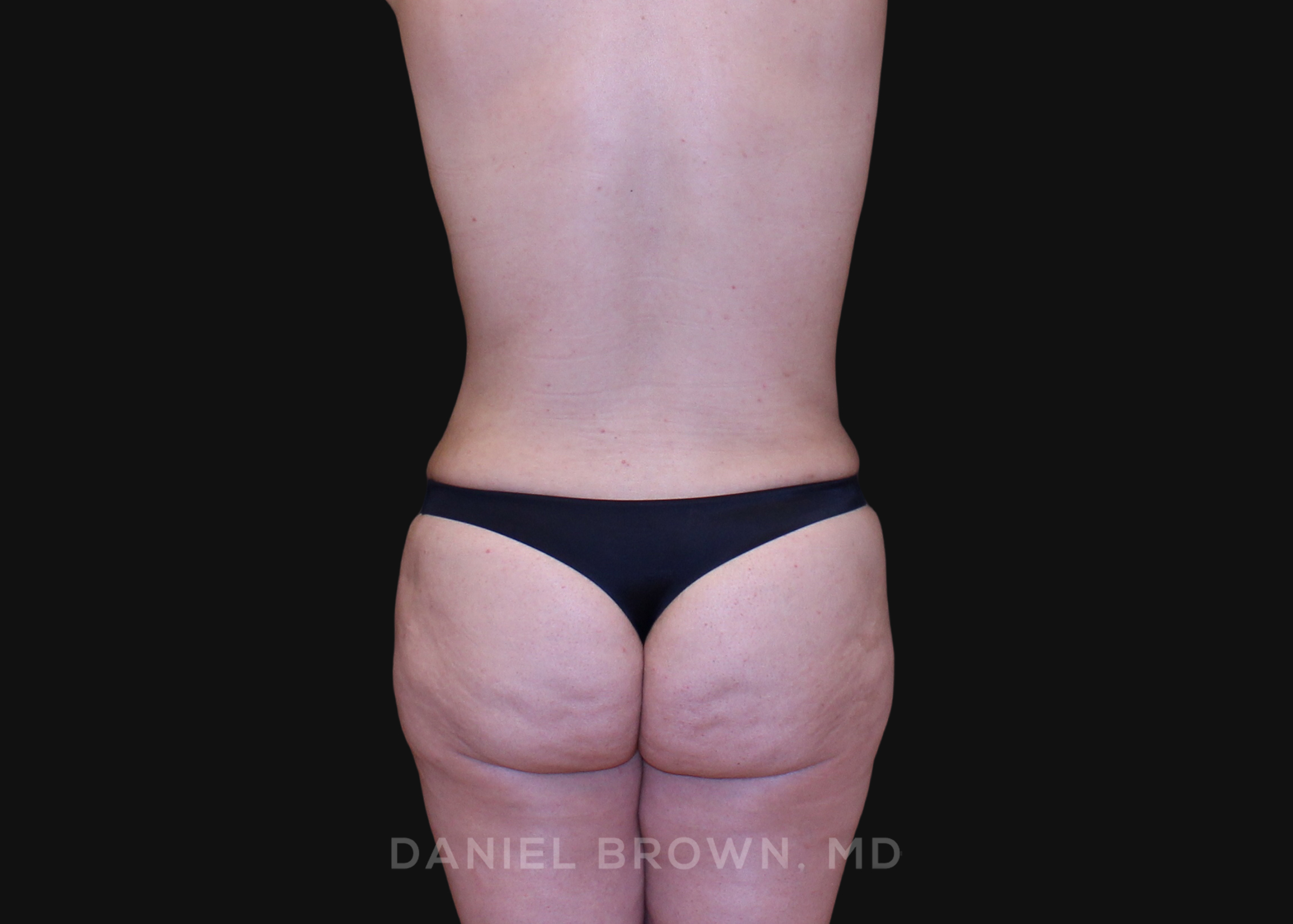 Tummy Tuck Patient Photo - Case 1187 - after view-5
