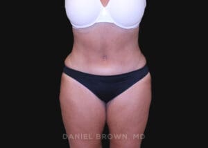 Tummy Tuck - Case 1200 - After