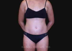 Tummy Tuck - Case 1239 - After