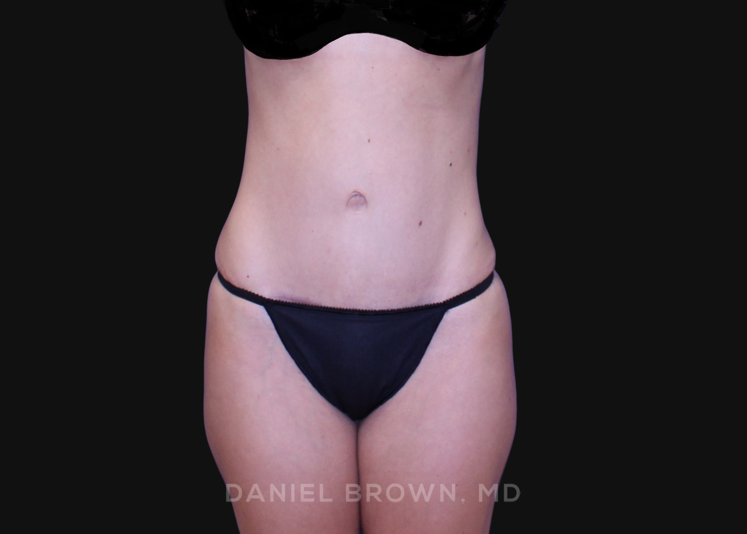 Tummy Tuck Patient Photo - Case 1265 - after view