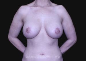 Periareolar Breast Lift/Aug - Case 1304 - After