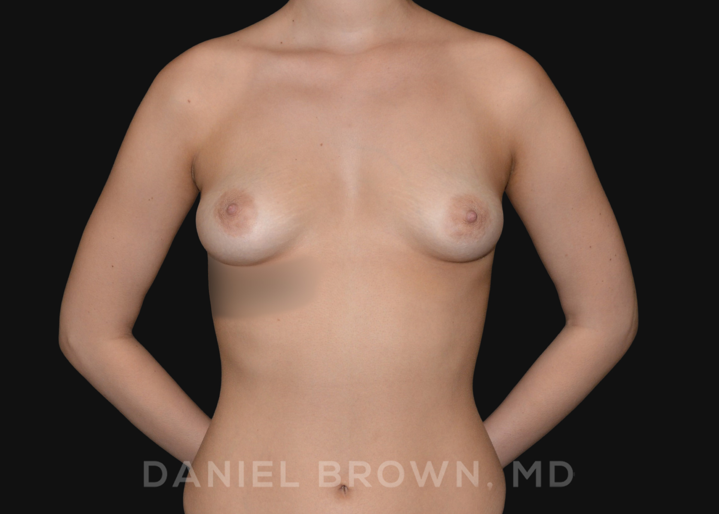 Breast Lift with Augmentation, Daniel Brown M.D