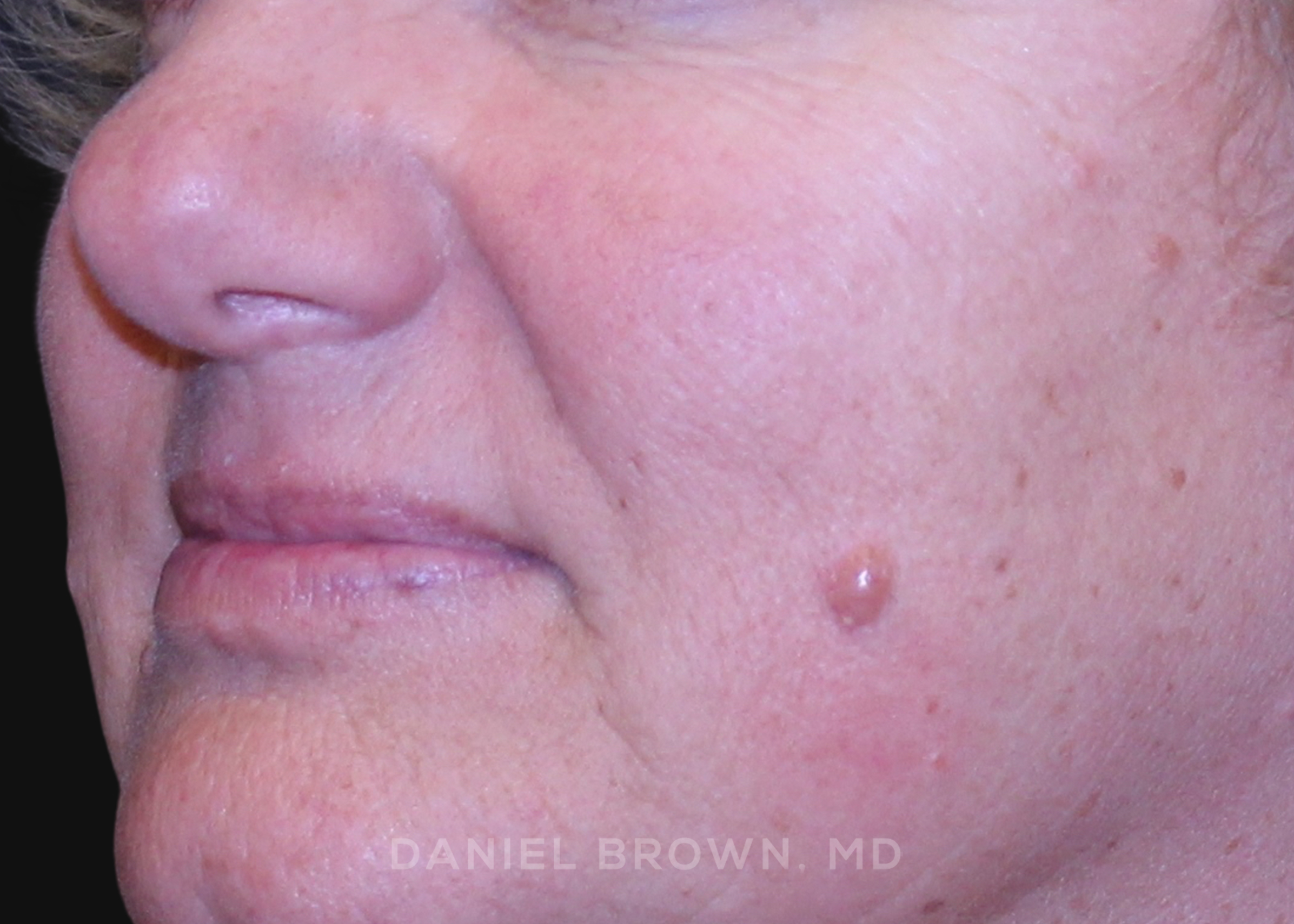 Mole Removal Patient Photo - Case 1559 - before view-