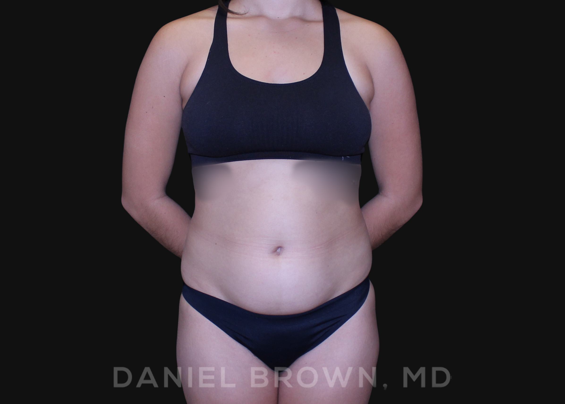 Contour Liposuction, Daniel Brown M.D