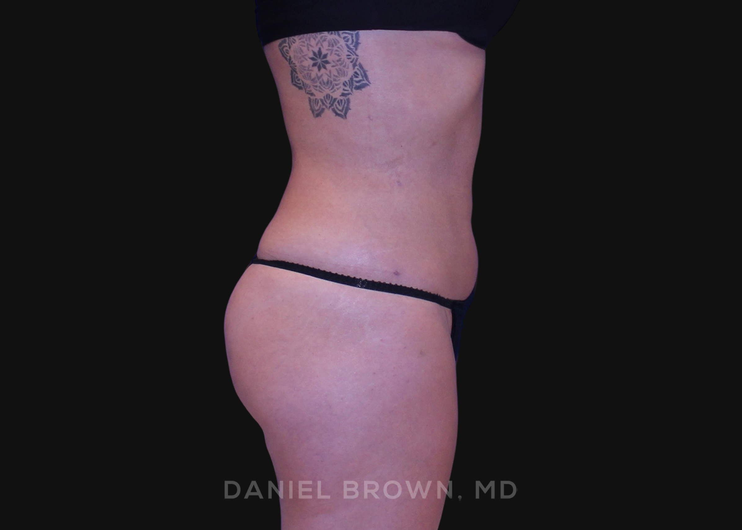 Liposuction Patient Photo - Case 1675 - after view-4