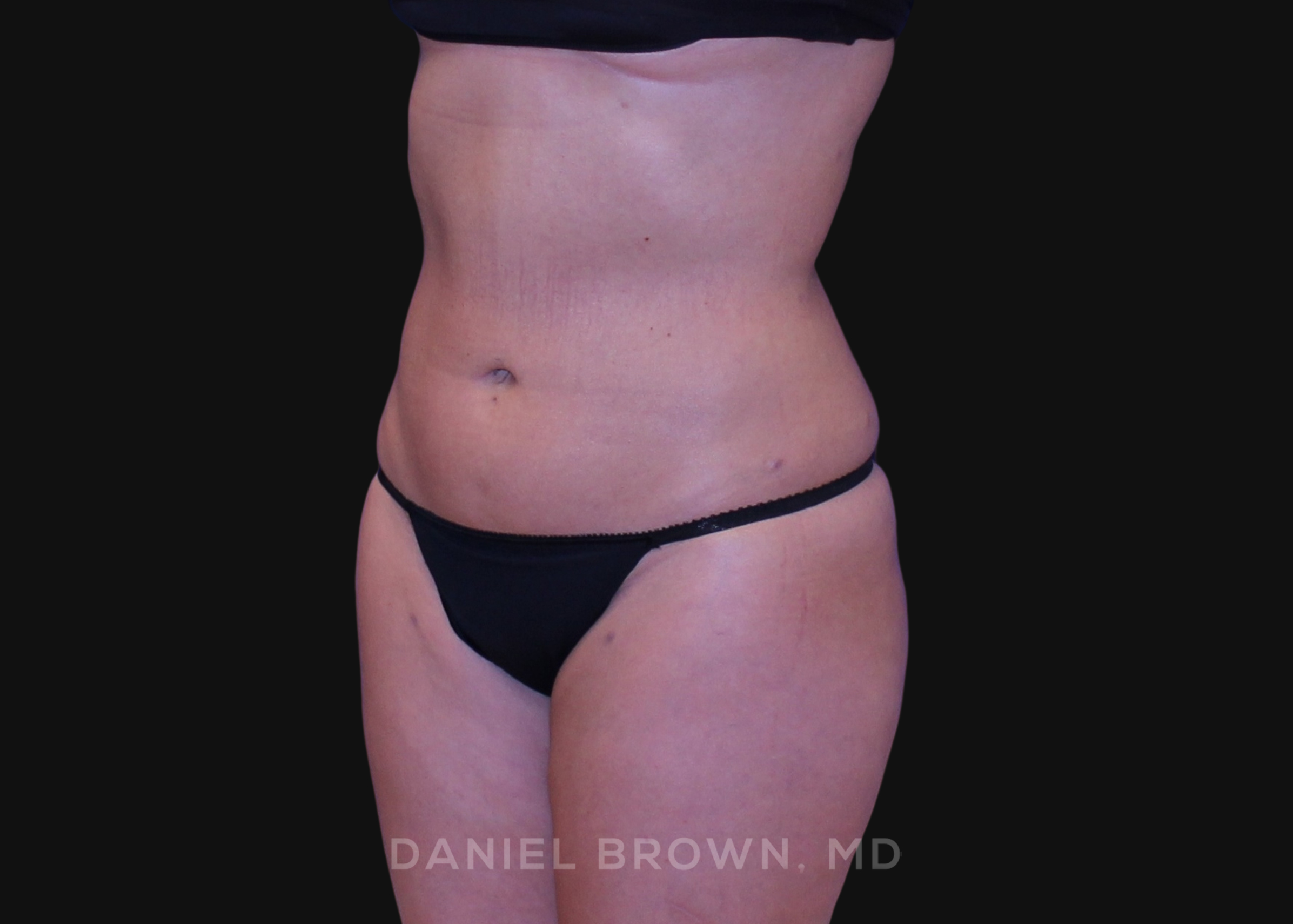 Liposuction Patient Photo - Case 1675 - after view-2