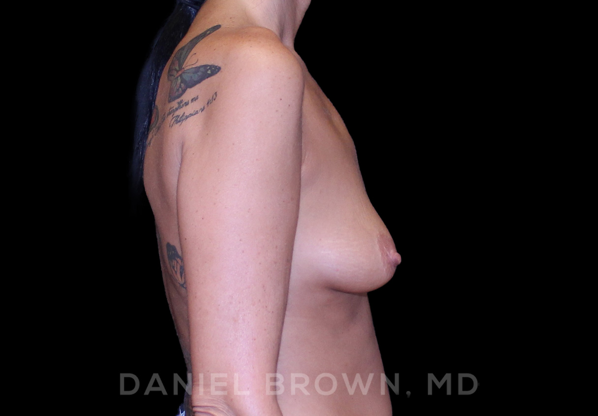 Breast LIft & Implant Patient Photo - Case 1784 - before view-