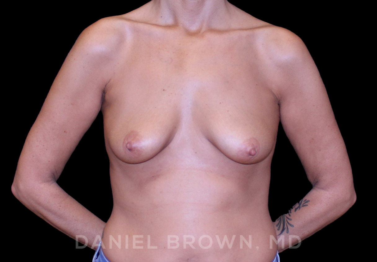 Breast LIft & Implant Patient Photo - Case 1784 - before view-0
