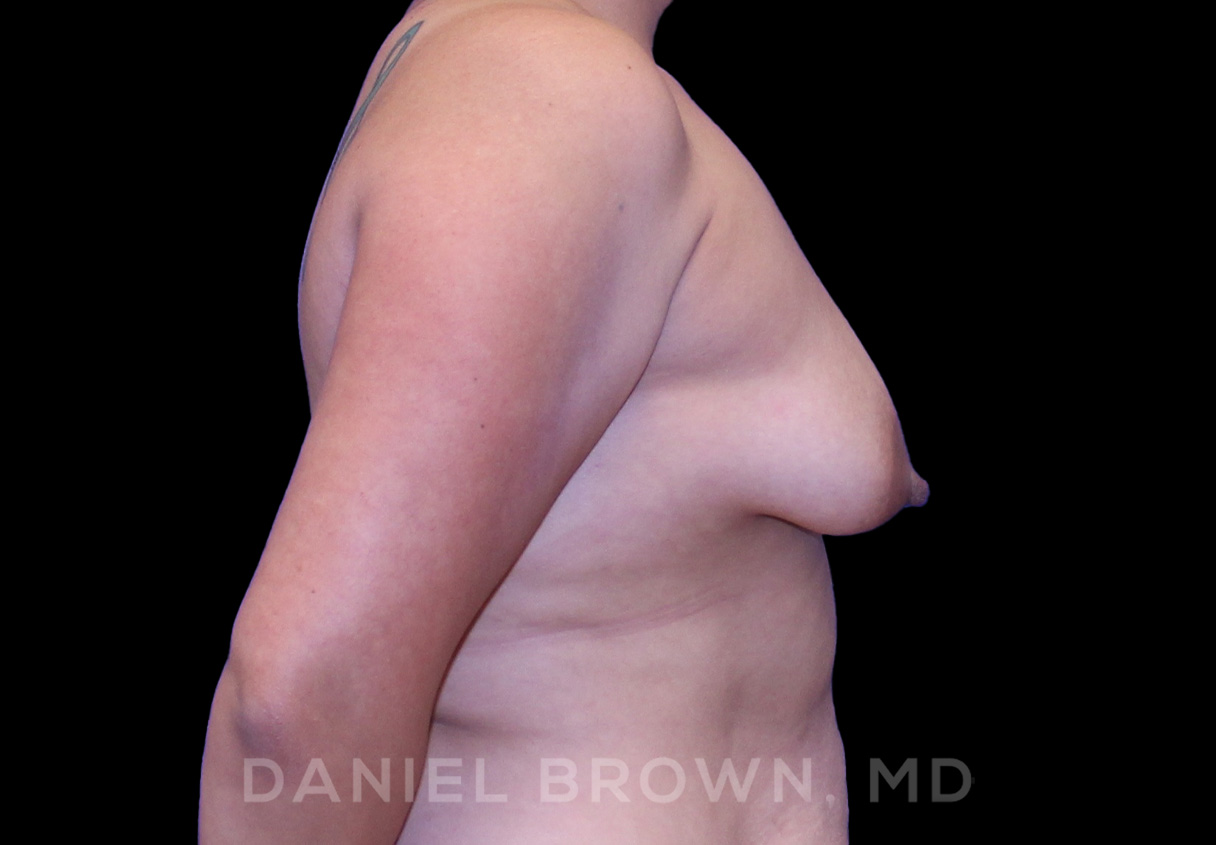 Breast LIft & Implant Patient Photo - Case 1806 - before view-