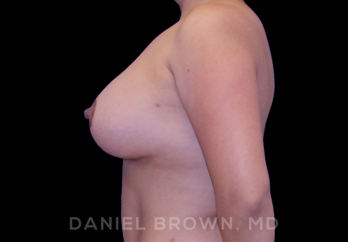 Breast LIft & Implant Patient Photo - Case 1806 - after view-3