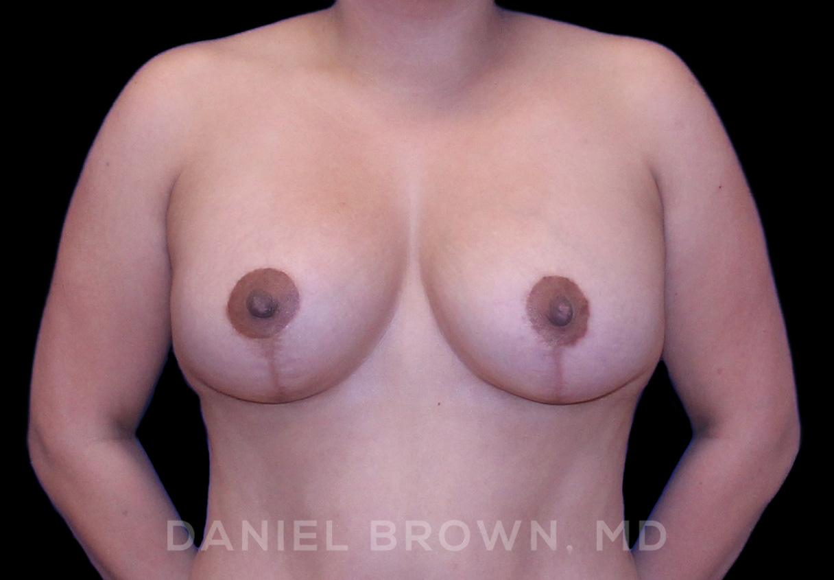 Breast LIft & Implant Patient Photo - Case 1806 - after view-0