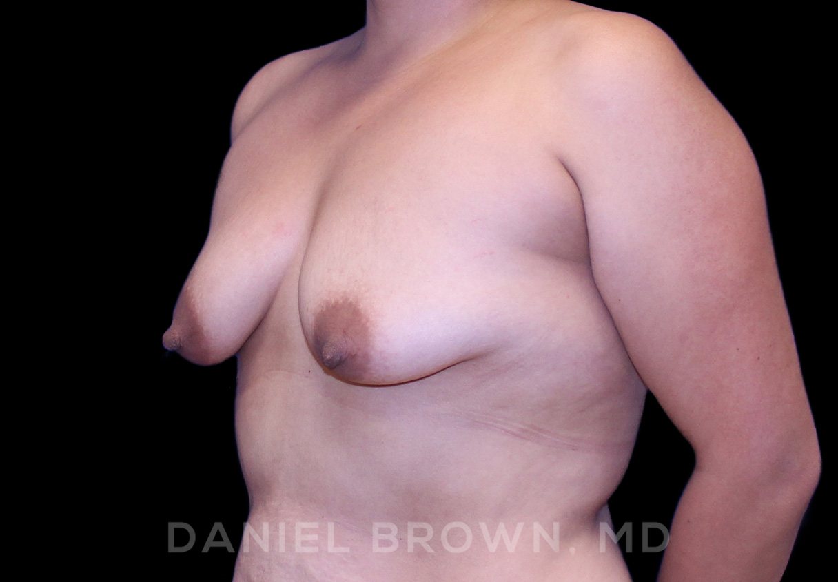 Breast LIft & Implant Patient Photo - Case 1806 - before view-1