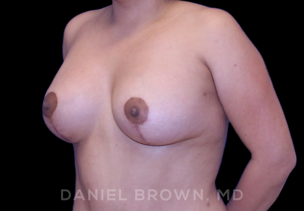 Breast LIft & Implant Patient Photo - Case 1806 - after view-1
