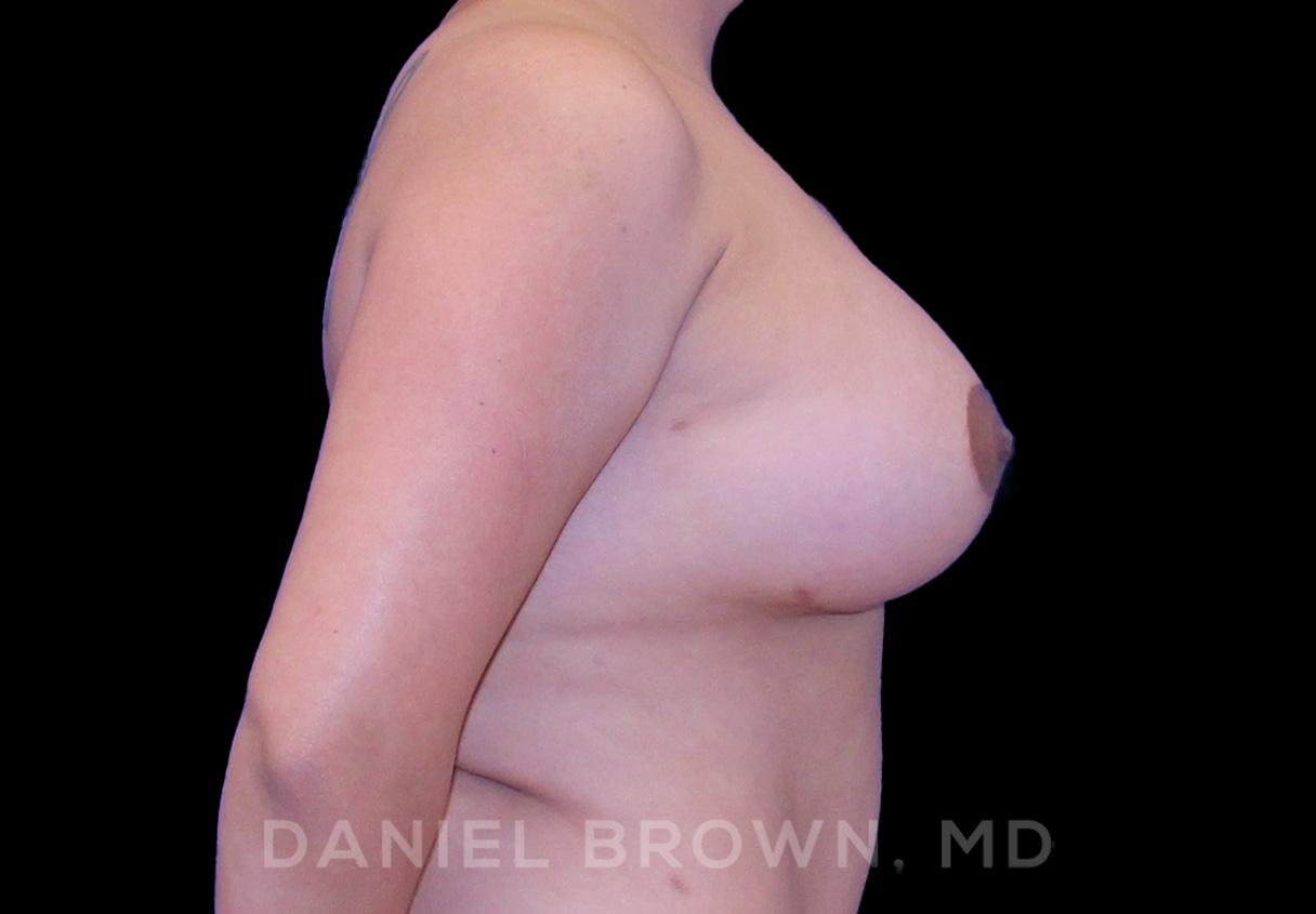 Breast LIft & Implant Patient Photo - Case 1806 - after view-4