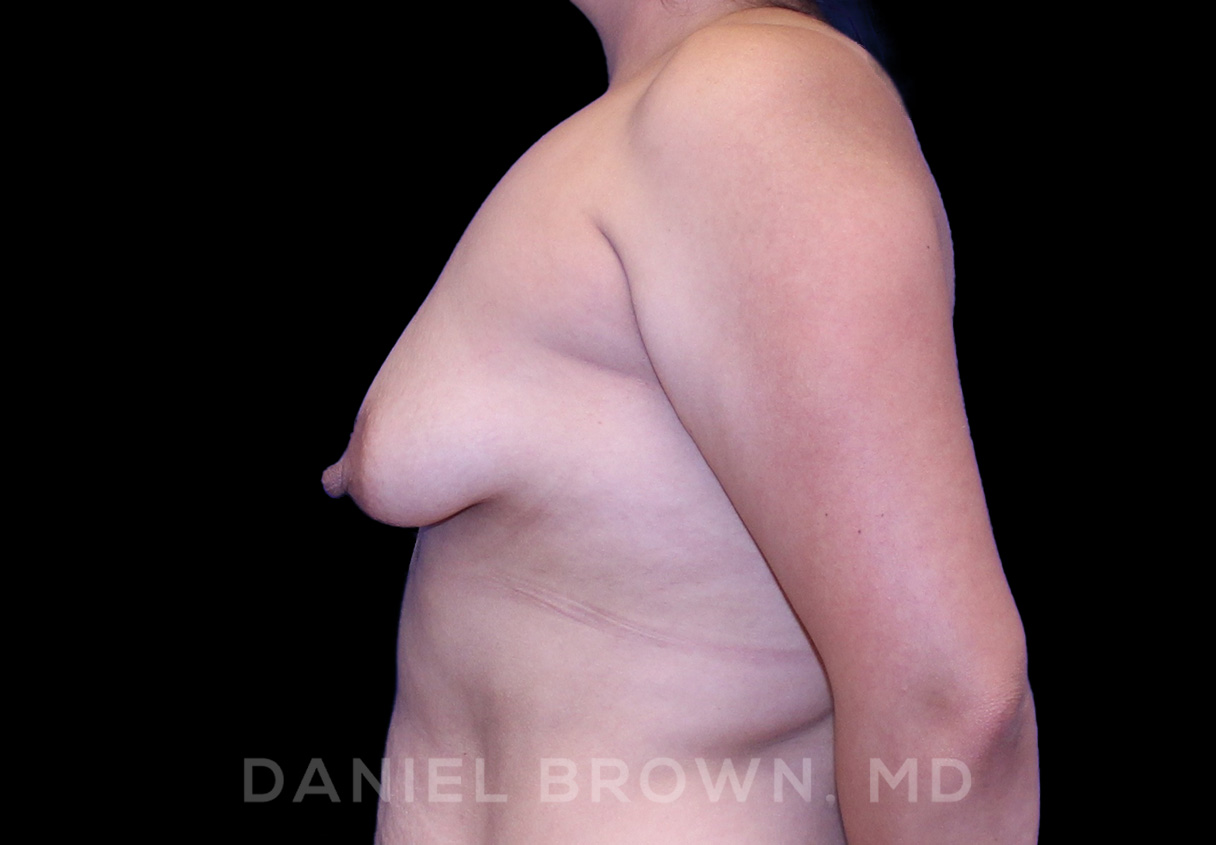 Breast LIft & Implant Patient Photo - Case 1806 - before view-