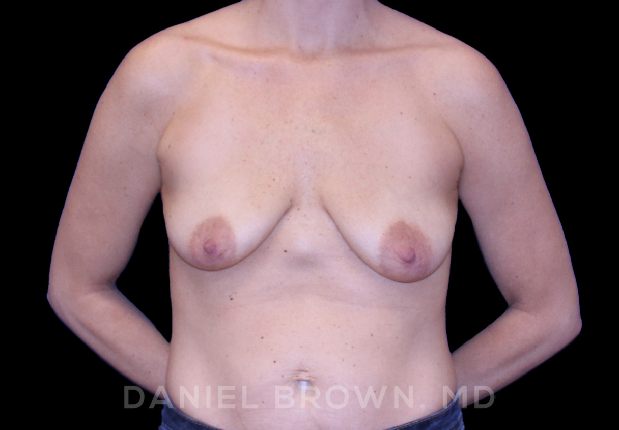 Breast LIft & Implant Patient Photo - Case 1817 - before view-