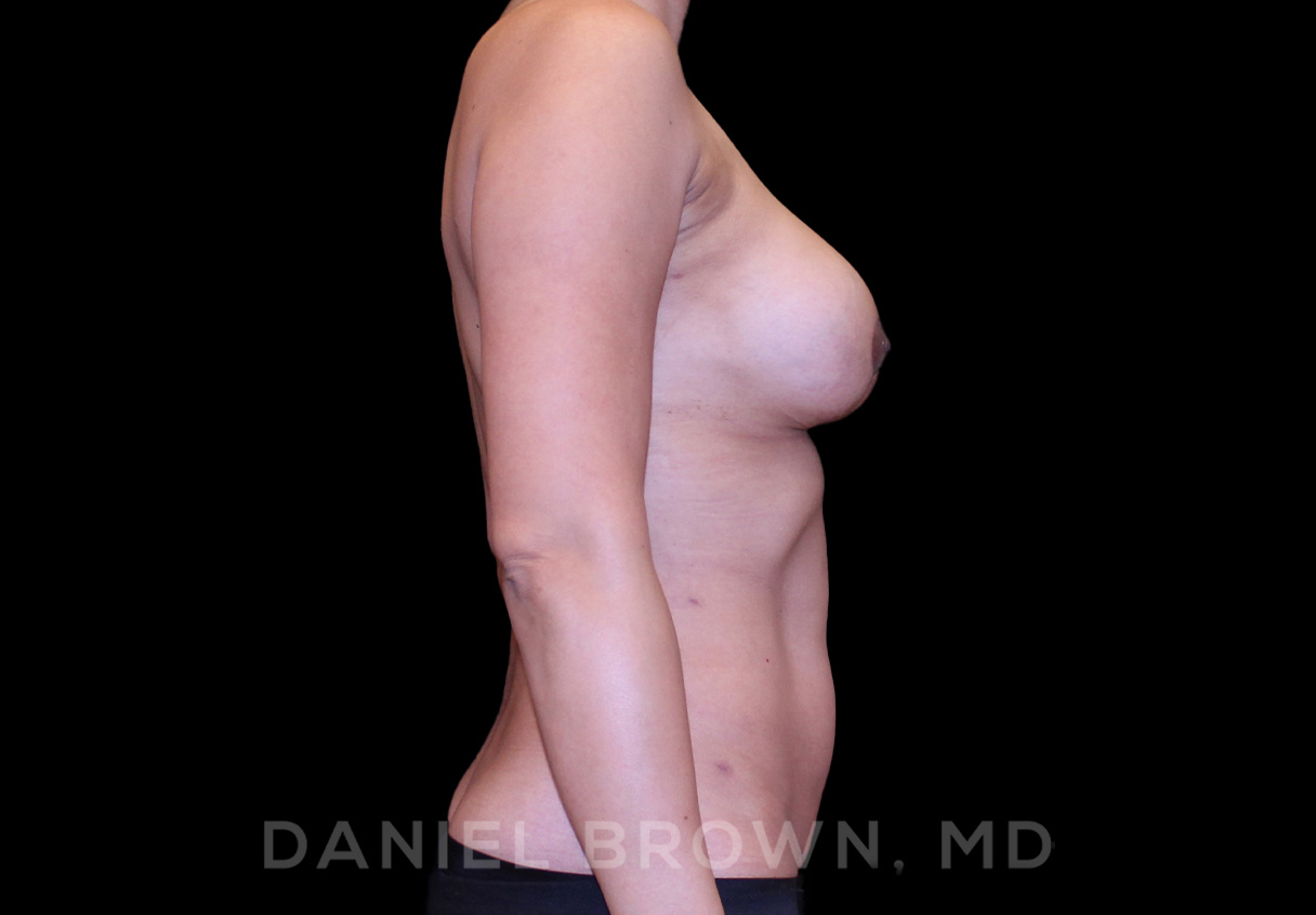 Breast LIft & Implant Patient Photo - Case 1839 - after view