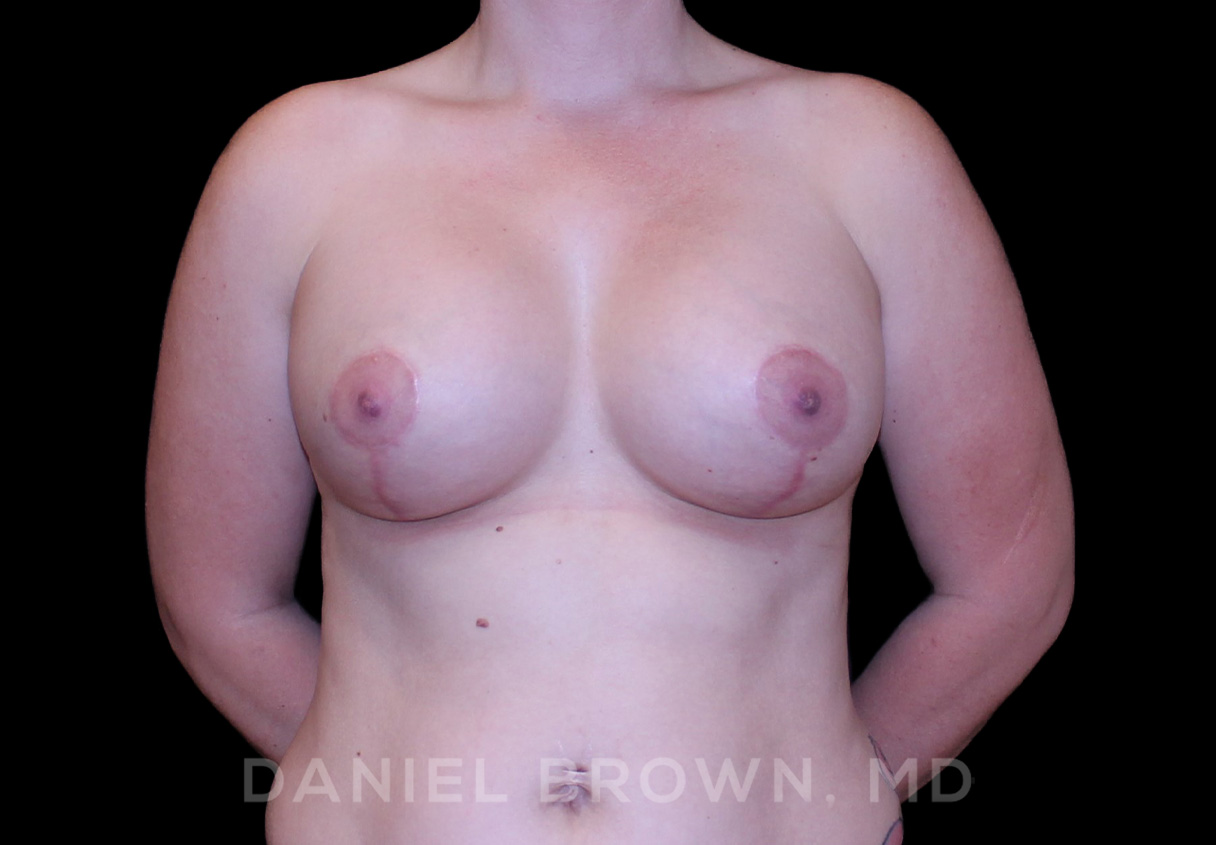 Breast LIft & Implant Patient Photo - Case 1872 - after view