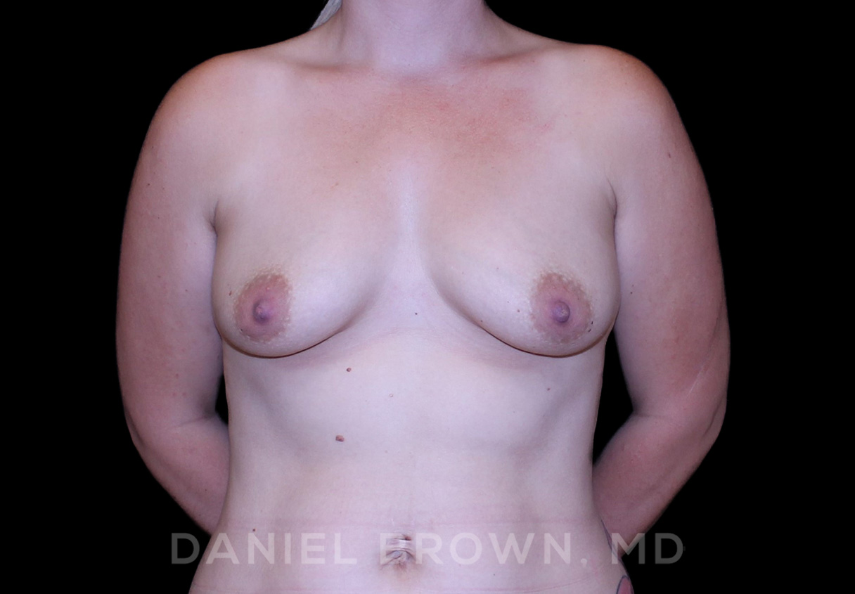 Breast LIft & Implant Patient Photo - Case 1872 - before view-0