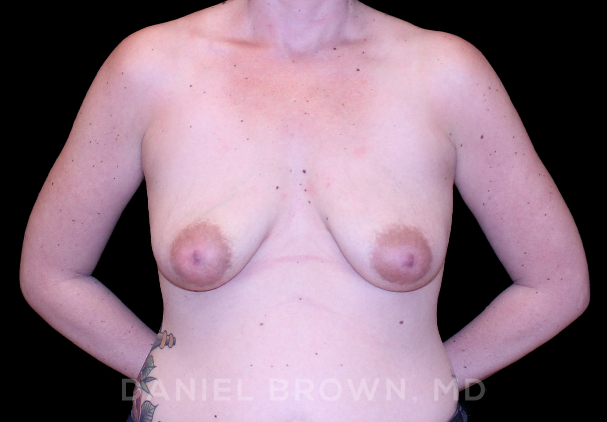 Breast Implants, Daniel Brown M.D
