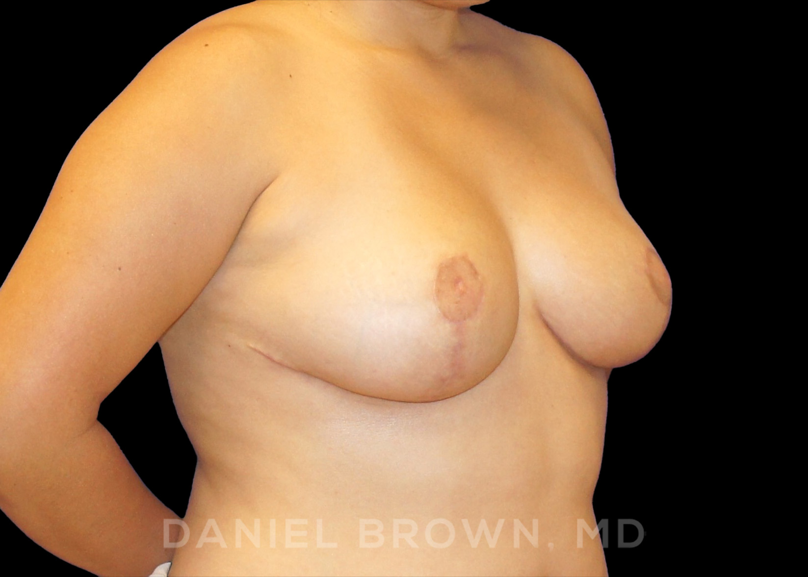 Breast Reduction Patient Photo - Case 1930 - after view-2
