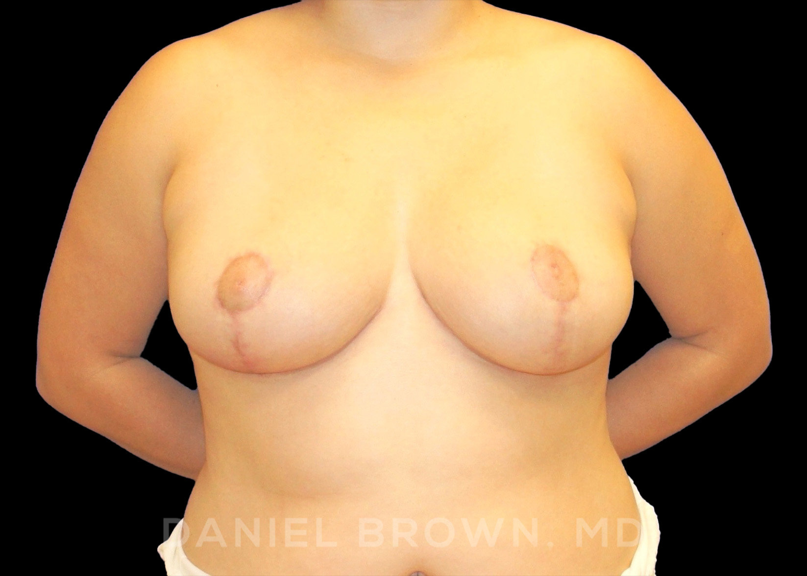 Breast Reduction Patient Photo - Case 1930 - after view-0
