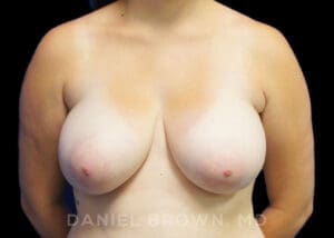 Breast Reduction - Case 1948 - Before