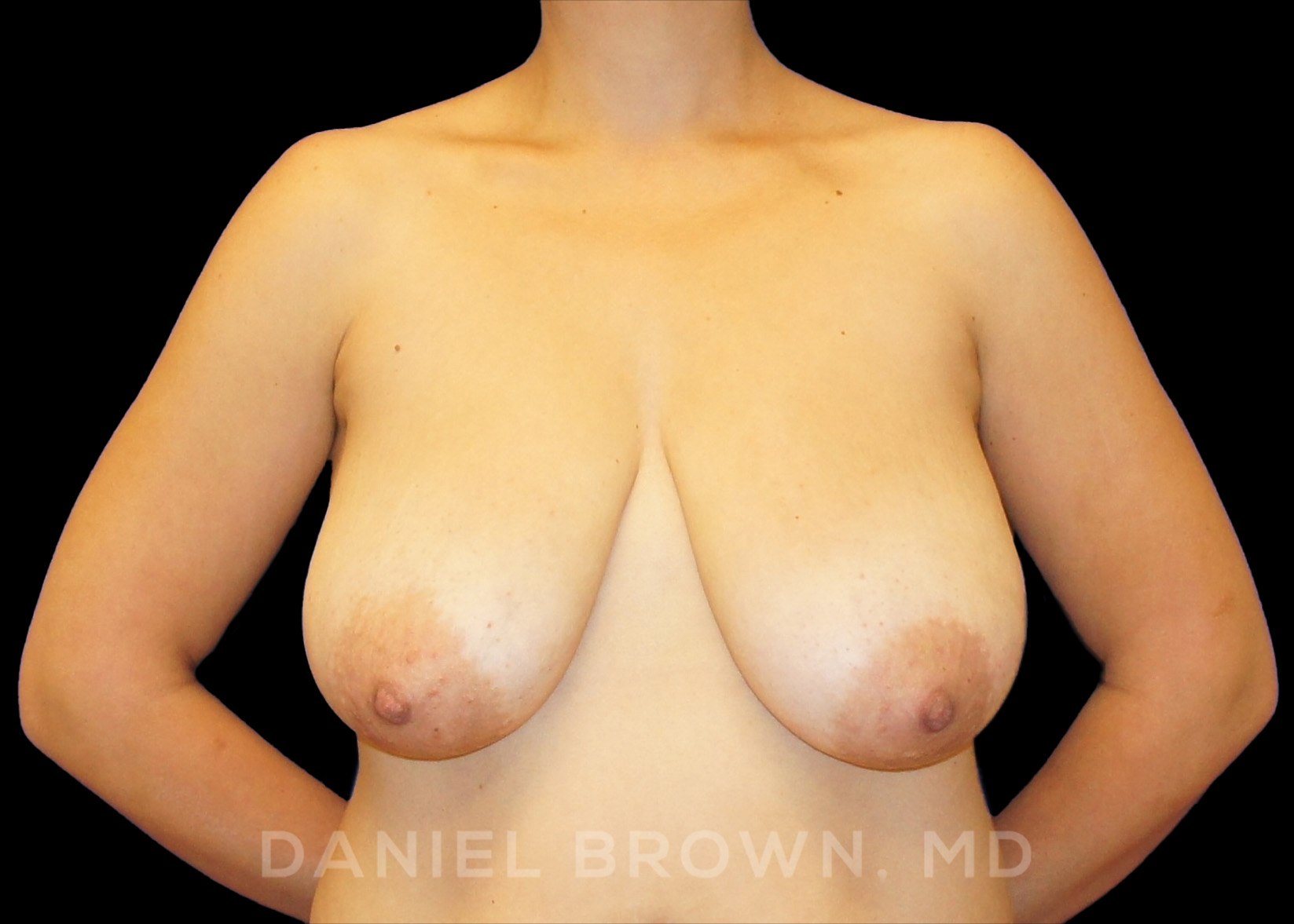 Breast Reduction, Daniel Brown M.D