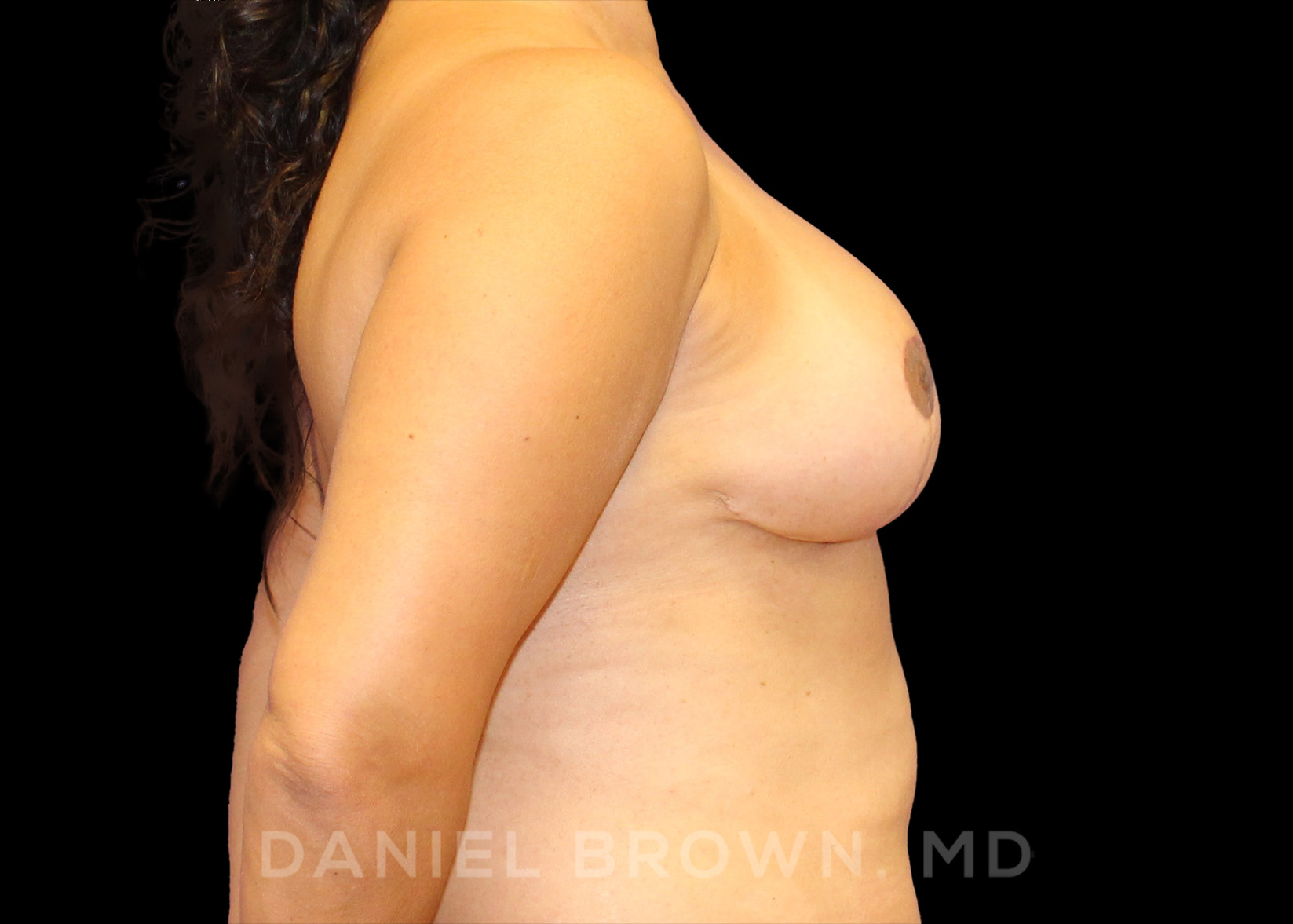 Breast Reduction Patient Photo - Case 1977 - after view
