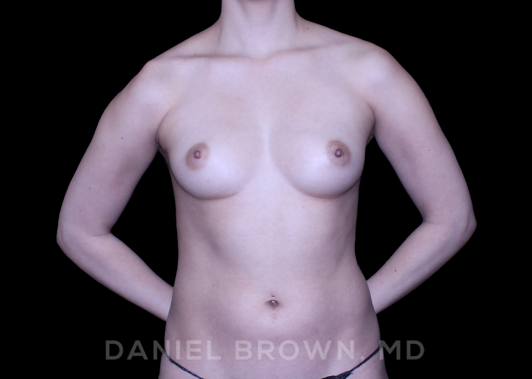 Breast Fat Transfer, Daniel Brown M.D