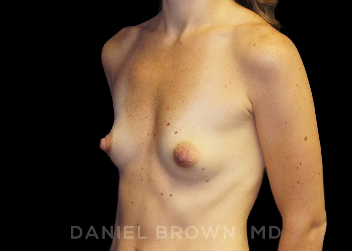 Breast Augmentation Patient Photo - Case 2055 - before view-1