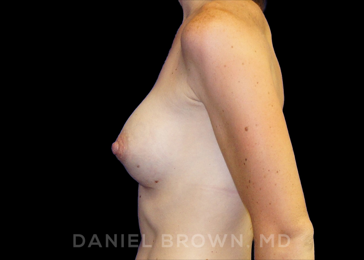 Breast Augmentation Patient Photo - Case 2055 - after view-2