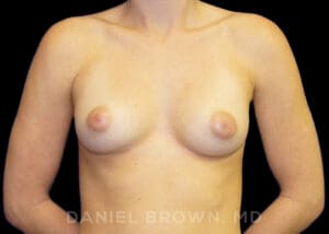 Breast Augmentation - Case 2063 - Before