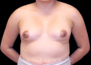 Breast Augmentation - Case 2070 - Before