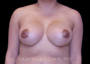 Breast Augmentation - Case 2070 - After