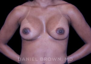 Breast Augmentation - Case 2091 - After