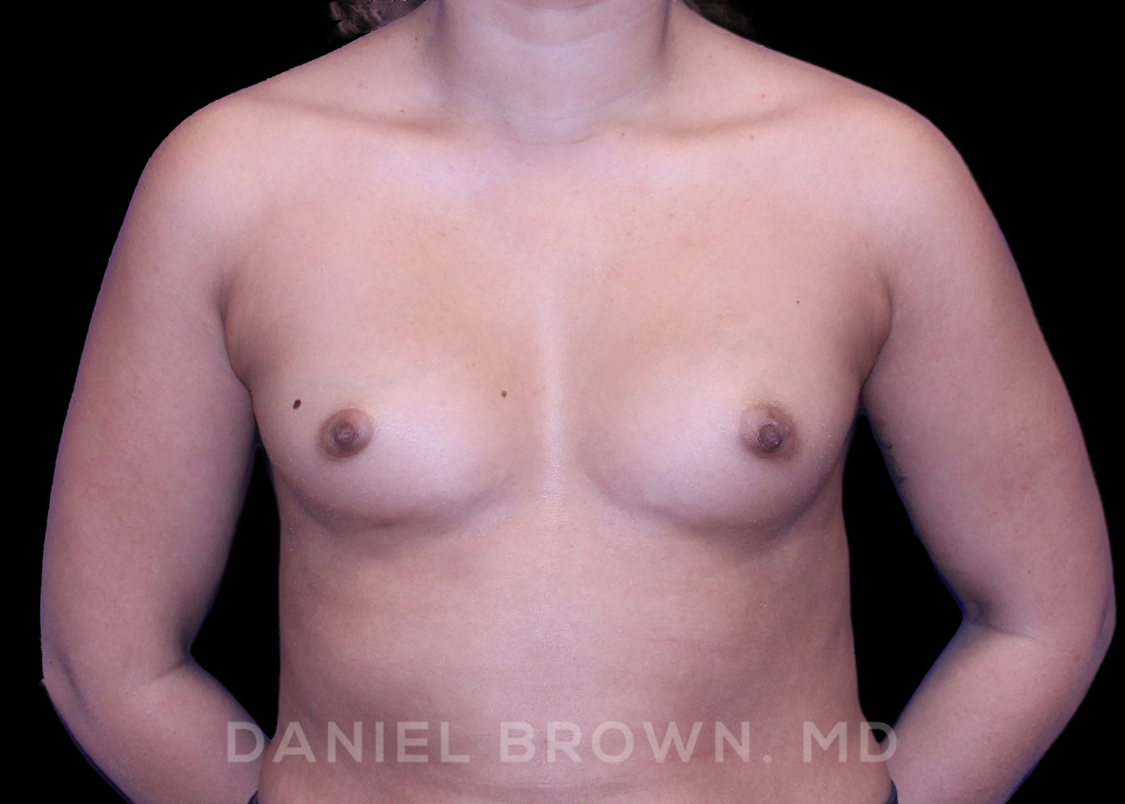 Breast Augmentation Patient Photo - Case 2098 - before view-