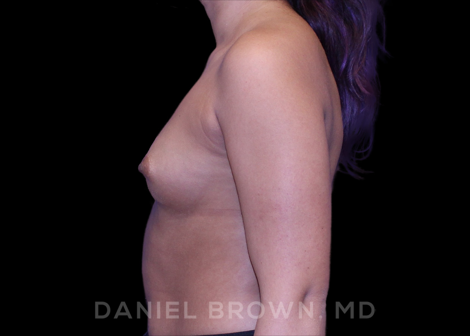 Breast Augmentation Patient Photo - Case 2098 - before view-