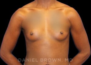 Breast Augmentation - Case 2105 - Before