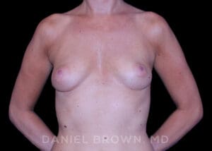 Breast Augmentation - Case 2112 - Before