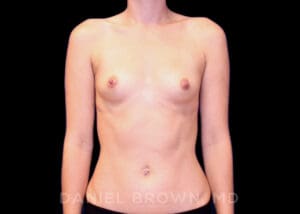 Breast Augmentation - Case 2119 - Before