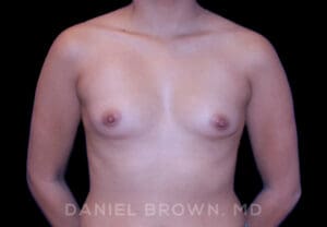 Breast Augmentation - Case 2148 - Before