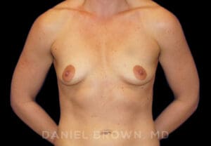 Breast Augmentation - Case 2170 - Before