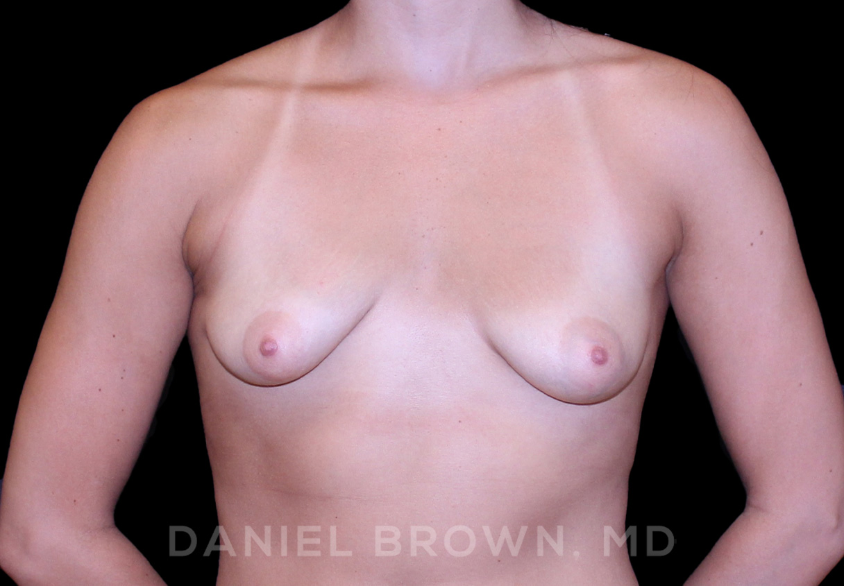 Breast Augmentation Patient Photo - Case 2181 - before view-