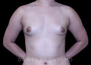Breast Augmentation - Case 2192 - Before