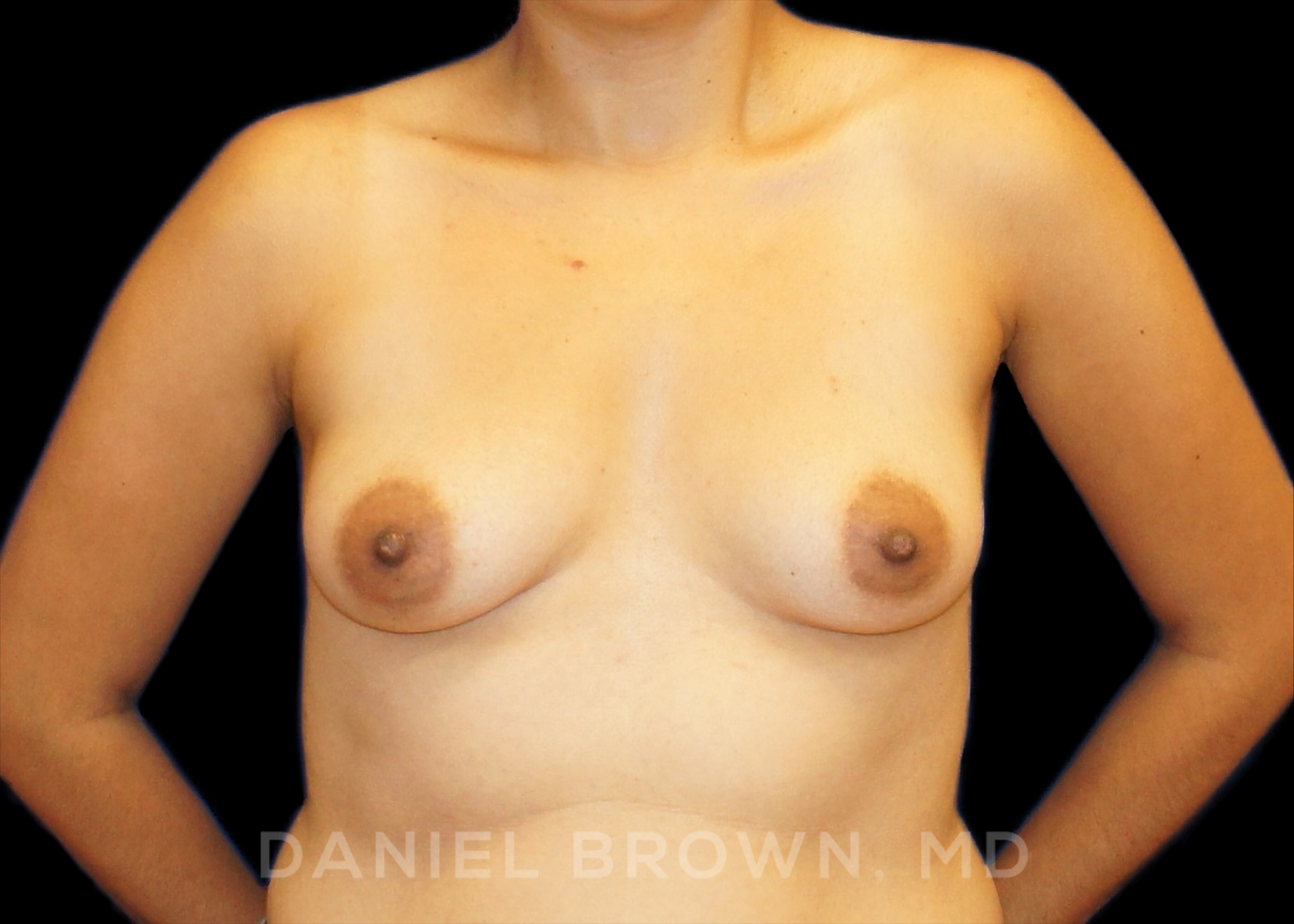 Breast Augmentation Patient Photo - Case 2203 - before view-0