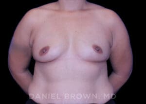 Breast Augmentation - Case 2210 - Before